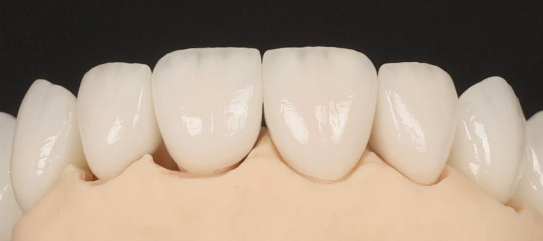 Macrofotografie a unei lucrări ceramice stratificate pe model, cu mască gingivală, pe fond negru. Prin glazură se văd textura suprafeței și striațiile de mamelon de la marginea incizală.